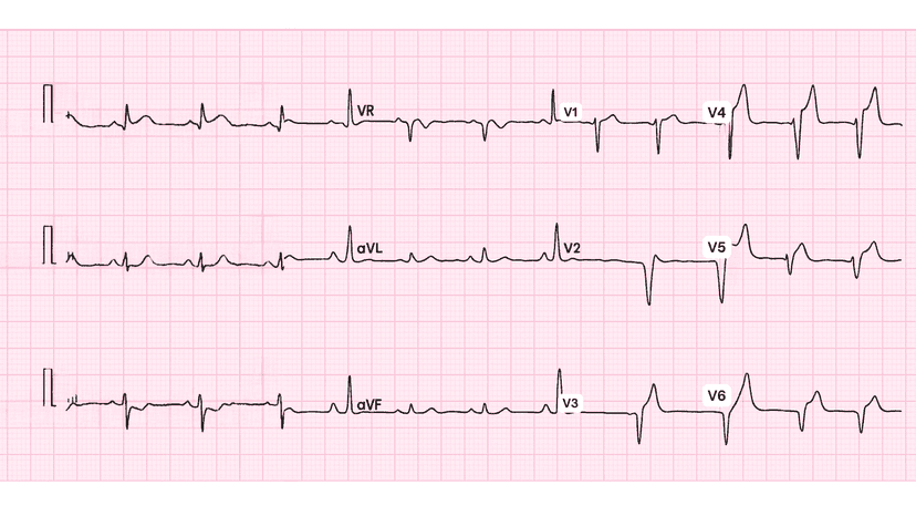 Anterior Wall Myocardial Infarction: Complete ECG Recognition and Emergency Management Guide