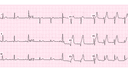 Anterior Wall Myocardial Infarction: Advanced ECG Patterns and Clinical Pearls
