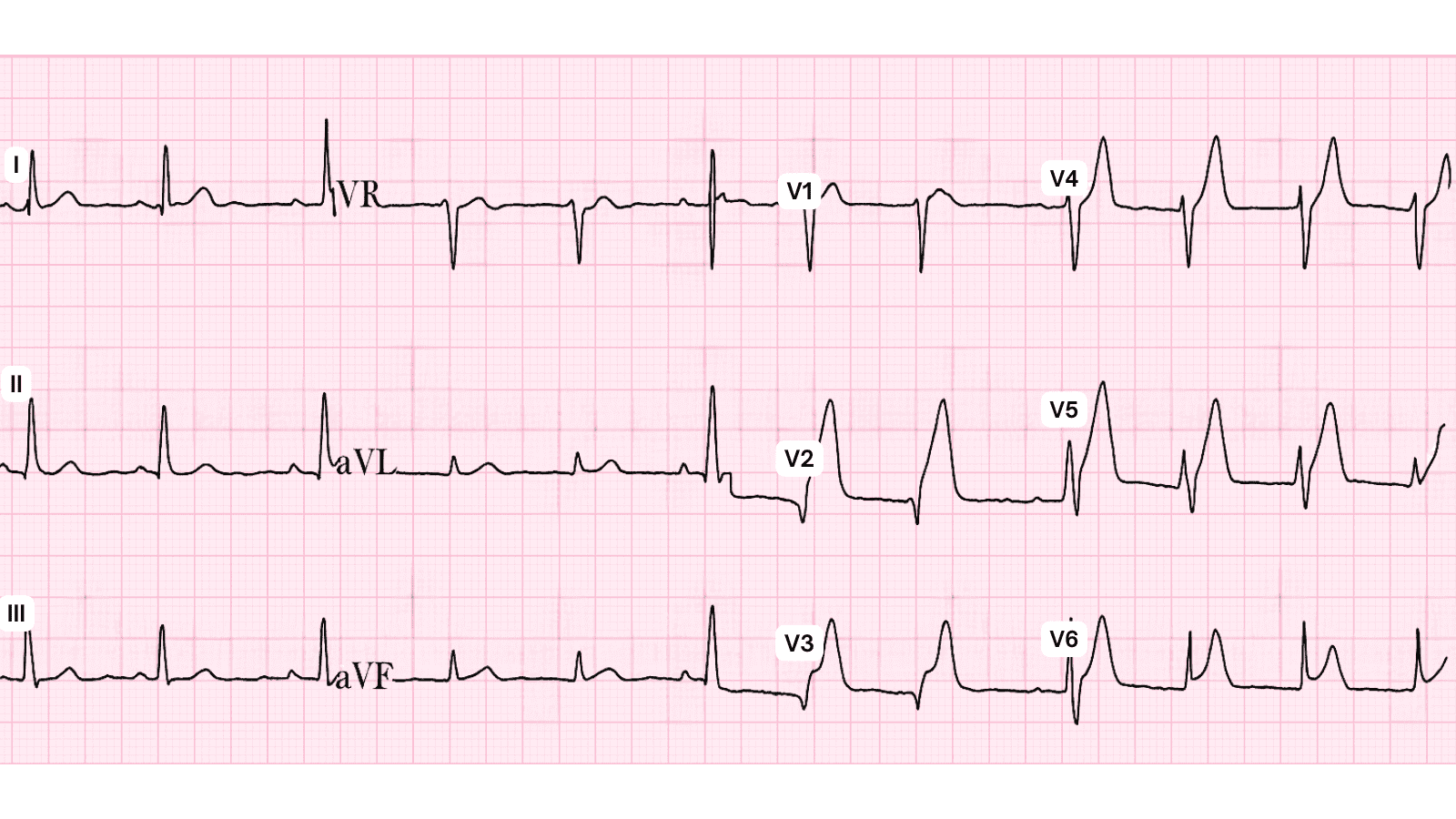 Anterior Wall Myocardial Infarction: Advanced ECG Patterns and Clinical Pearls