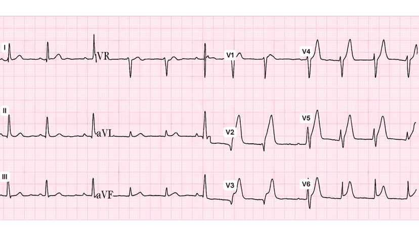 Anterior Wall Myocardial Infarction: Advanced ECG Patterns and Clinical Pearls
