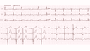 Anterolateral Myocardial Infarction: Advanced ECG Patterns and Clinical Pearls