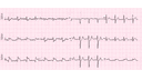 Inferior Wall Myocardial Infarction: Complete ECG Recognition and Emergency Management Guide