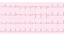 Inferior Wall Myocardial Infarction: Advanced ECG Patterns and Clinical Pearls