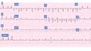 Cardiac Tamponade: Advanced ECG Recognition and Emergency Management