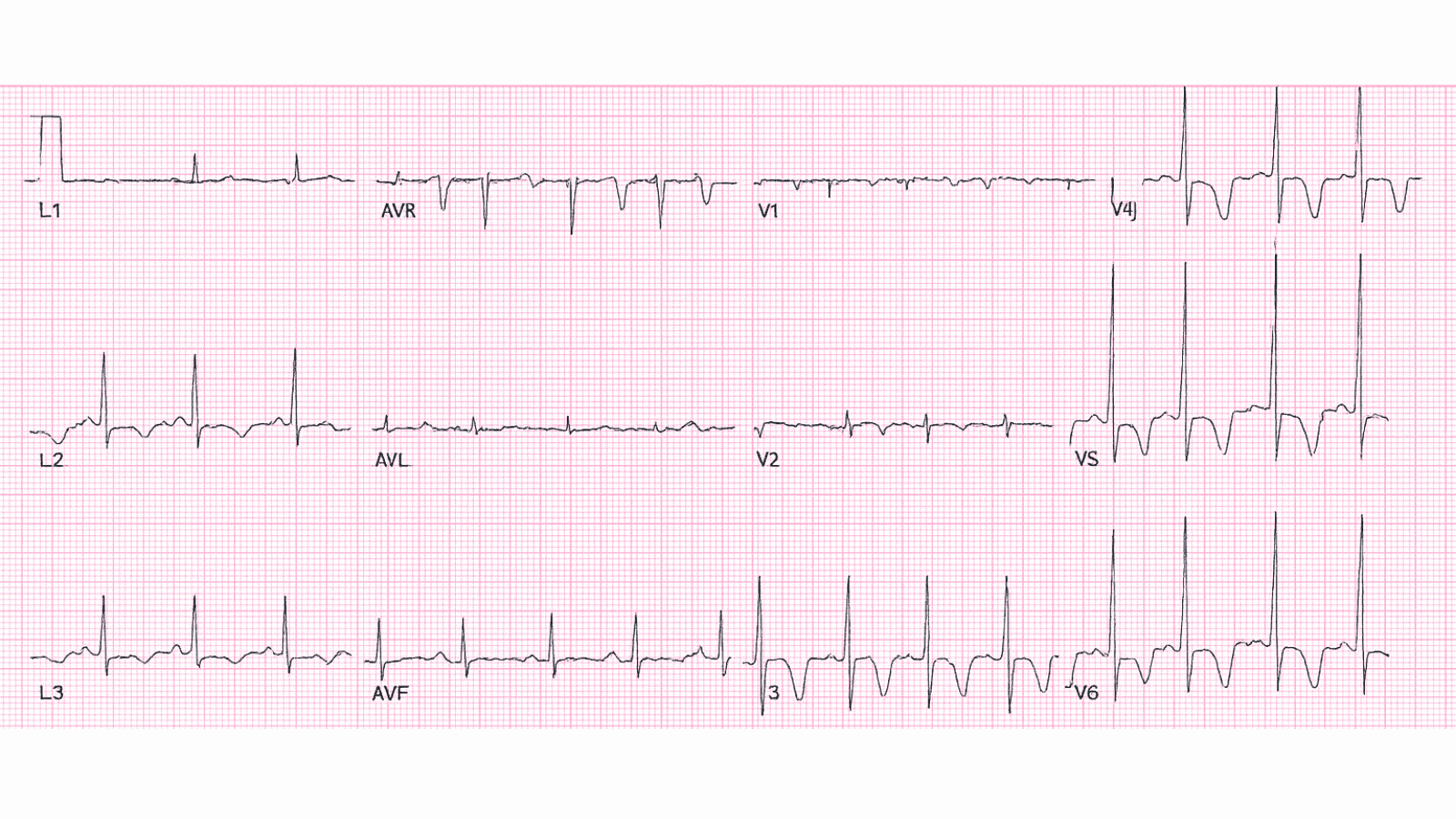 Dilated Cardiomyopathy with Global T Wave Inversion: Advanced ECG Recognition and Emergency Management