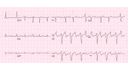 Early Repolarization: Advanced ECG Recognition and Emergency Management