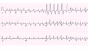 Left Bundle Branch Block (LBBB): Advanced ECG Recognition and Emergency Management