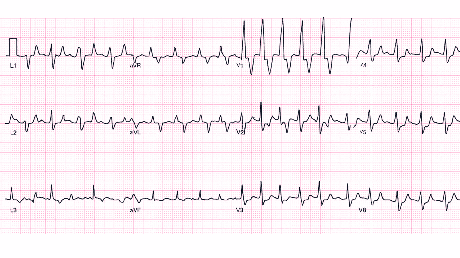 Left Bundle Branch Block (LBBB): Advanced ECG Recognition and Emergency Management
