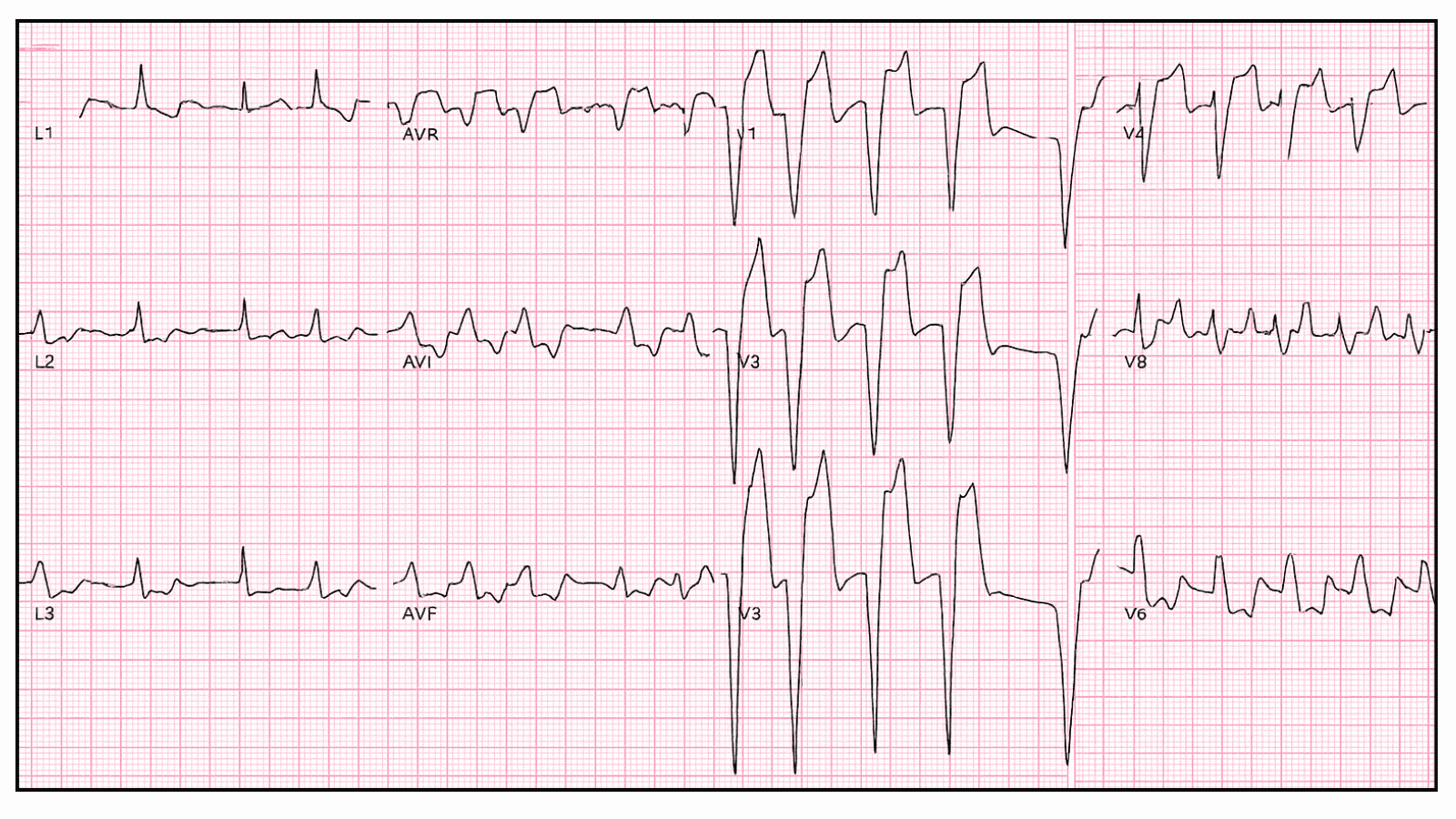 Monomorphic Ventricular Tachycardia: Advanced ECG Recognition and Emergency Management