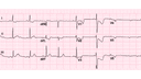 Posterior Wall Myocardial Infarction: Advanced ECG Recognition and Emergency Management