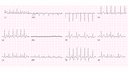 Supraventricular Tachycardia (SVT): Advanced ECG Recognition and Emergency Management