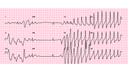 Torsades de Pointes: Advanced ECG Recognition and Emergency Management