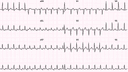 Wolff-Parkinson-White Syndrome (WPW): Advanced ECG Recognition and Emergency Management