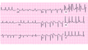 Atrial Fibrillation with Rapid Ventricular Response (RVR): Advanced ECG Recognition and Emergency Management