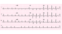 Atrial Flutter: Advanced ECG Recognition and Emergency Management