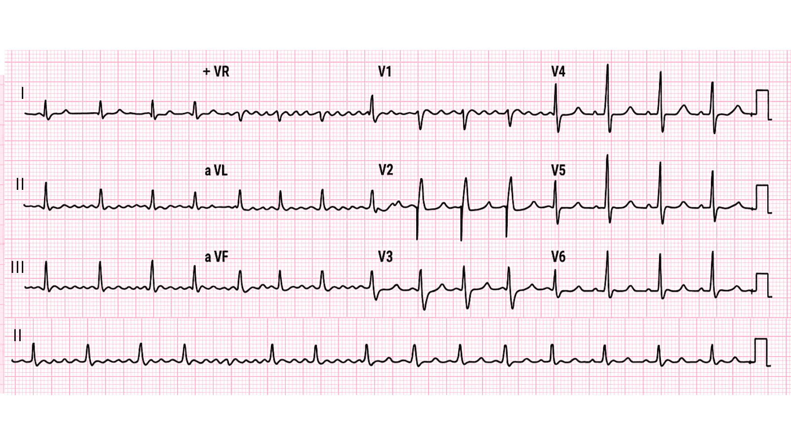 Atrial Flutter: Advanced ECG Recognition and Emergency Management