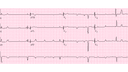 Complete Heart Block (Third Degree AV Block): Advanced ECG Recognition and Emergency Management