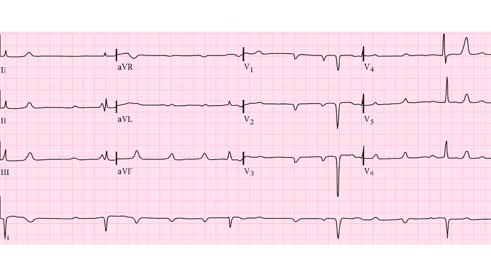 Complete Heart Block (Third Degree AV Block): Advanced ECG Recognition and Emergency Management
