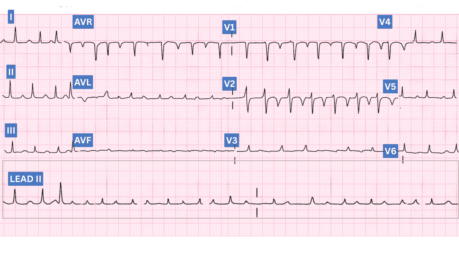 Electrical Alternans: Advanced ECG Recognition and Emergency Management