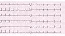Incomplete Right Bundle Branch Block: Advanced ECG Recognition and Emergency Management