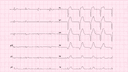 Lateral Wall Myocardial Infarction: Advanced ECG Recognition and Emergency Management