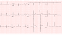 Long QT Syndrome: Advanced ECG Recognition and Emergency Management