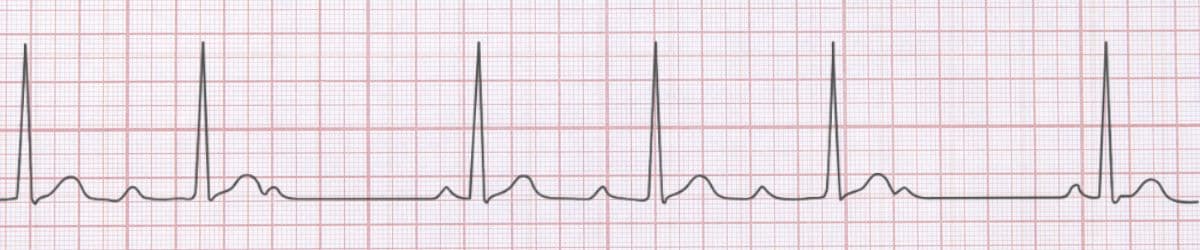 First Degree AV Block: ECG Recognition and Clinical Management