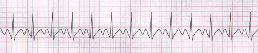 Normal Sinus Rhythm (NSR): The Foundation of ECG Interpretation