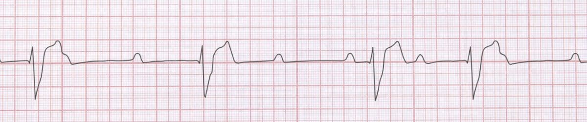 Complete Heart Block (Third Degree AV Block): ECG Recognition and Emergency Management