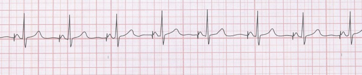 Atrial Paced Rhythm: ECG Recognition and Emergency Management