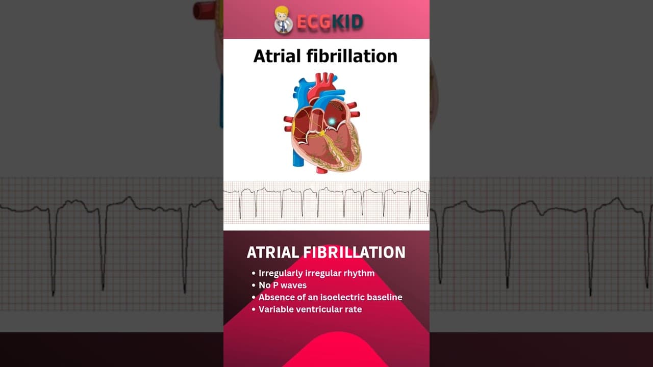 Atrial fibrillation #af #artrialfibrillation #heartfailure @ecgkid
