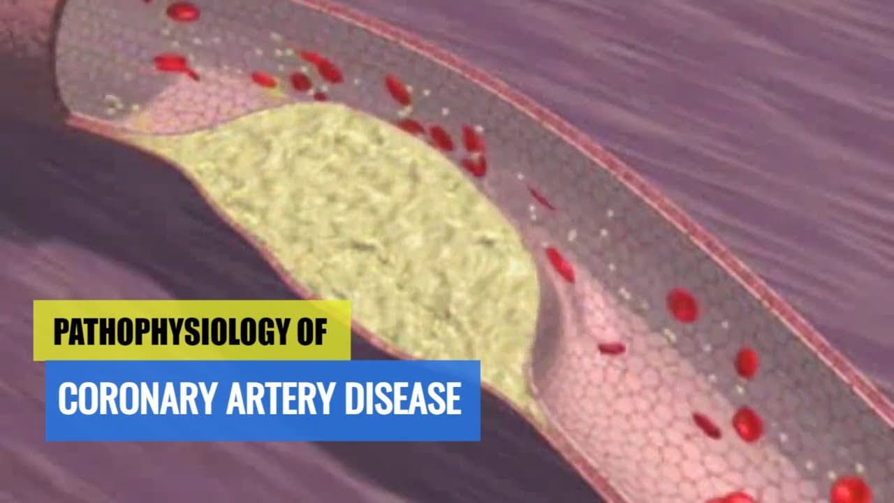 Pathophysiology of Coronary Artery Disease & ACS: Motion Animation