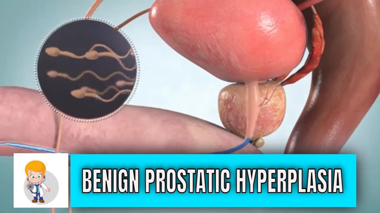 Benign prostatic hyperplasia (BPH): Causes, symptoms, diagnosis and treatment options