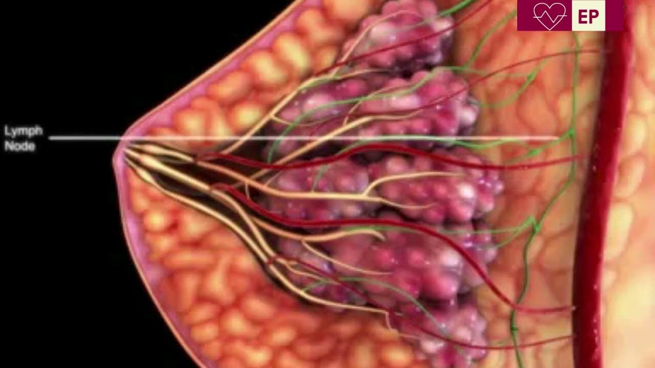 Expert guide on breast cancer and metastasis (How it spread?)