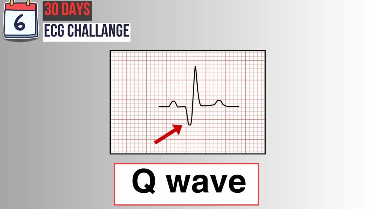 Day 6: Pathological Q waves on ECG | 30-Day ECG challenge