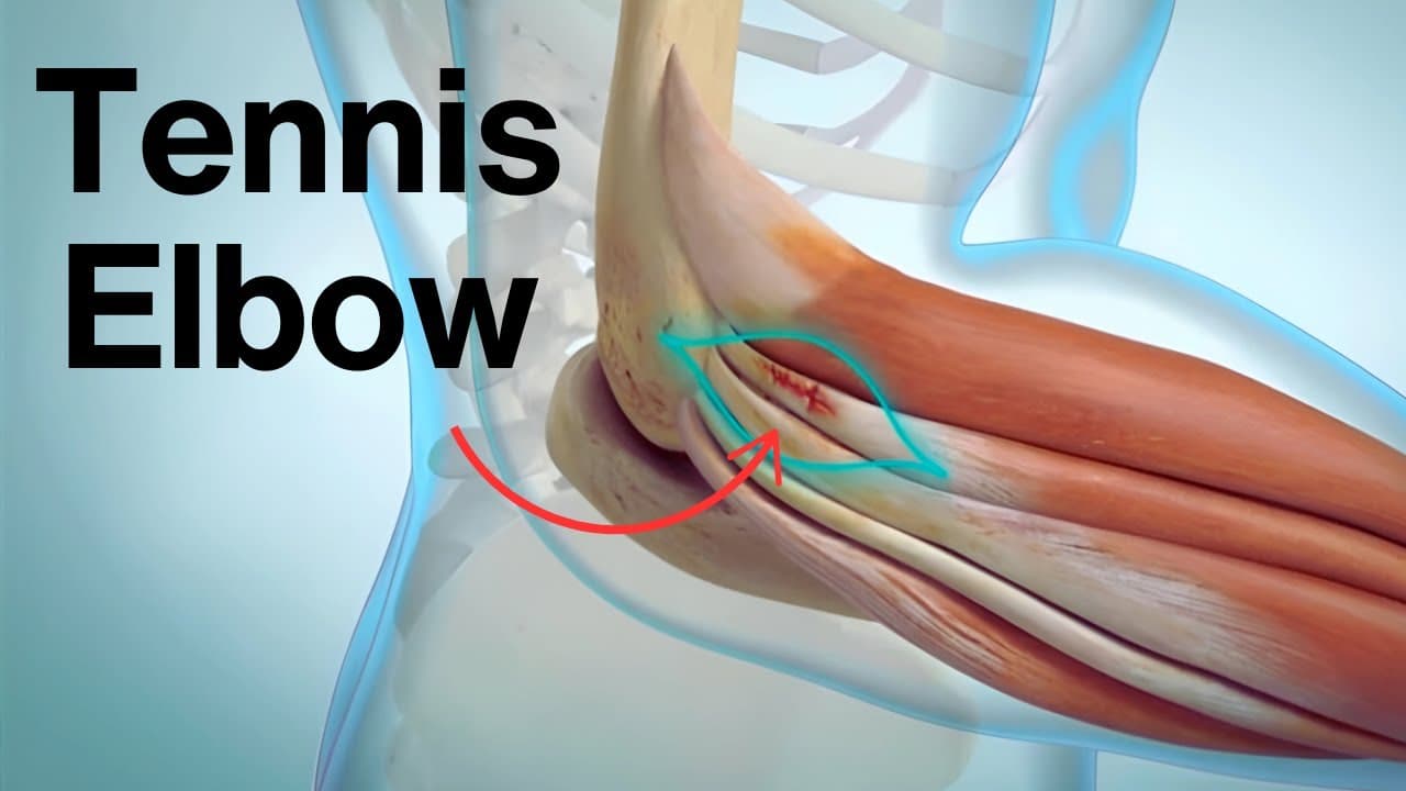 Tennis Elbow Explained: Symptoms, Causes, Treatment & Surgery (Medical Animation)