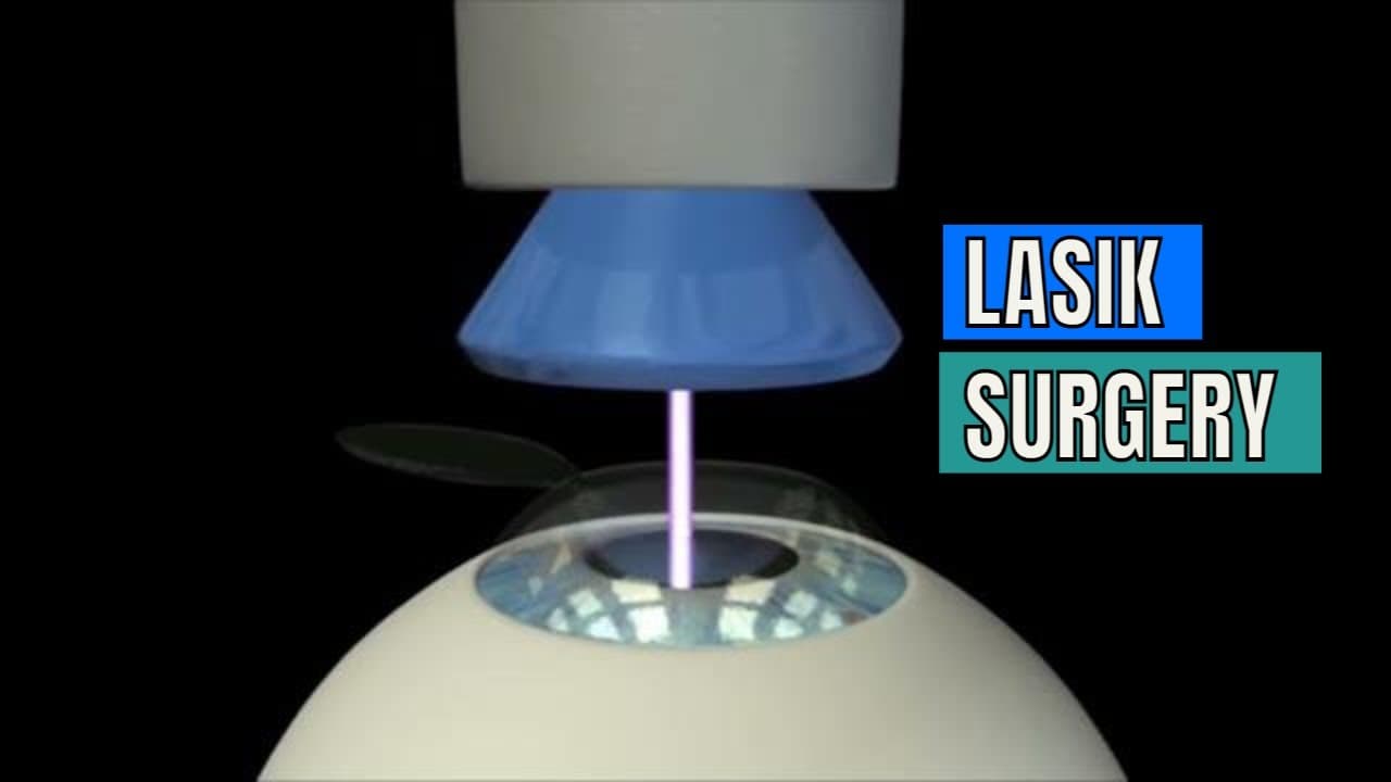 What is Lasik Surgery & how its performed?