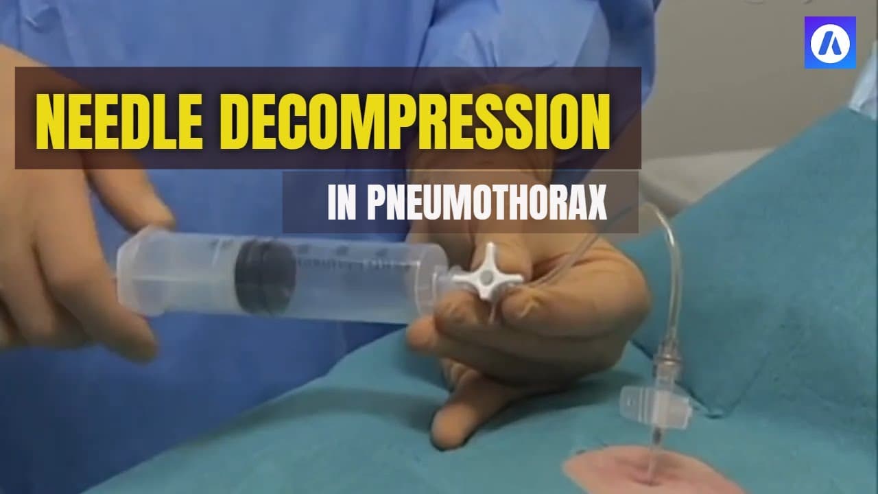 Needle Decompression Procedure in Pneumothorax | Step-by-Step Emergency Guide