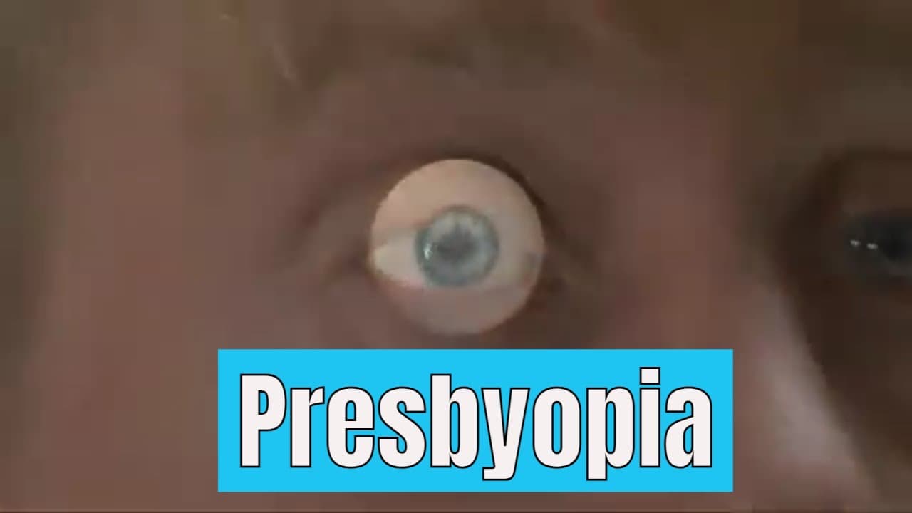 #Presbyopia : #Eye condition which alter #focus