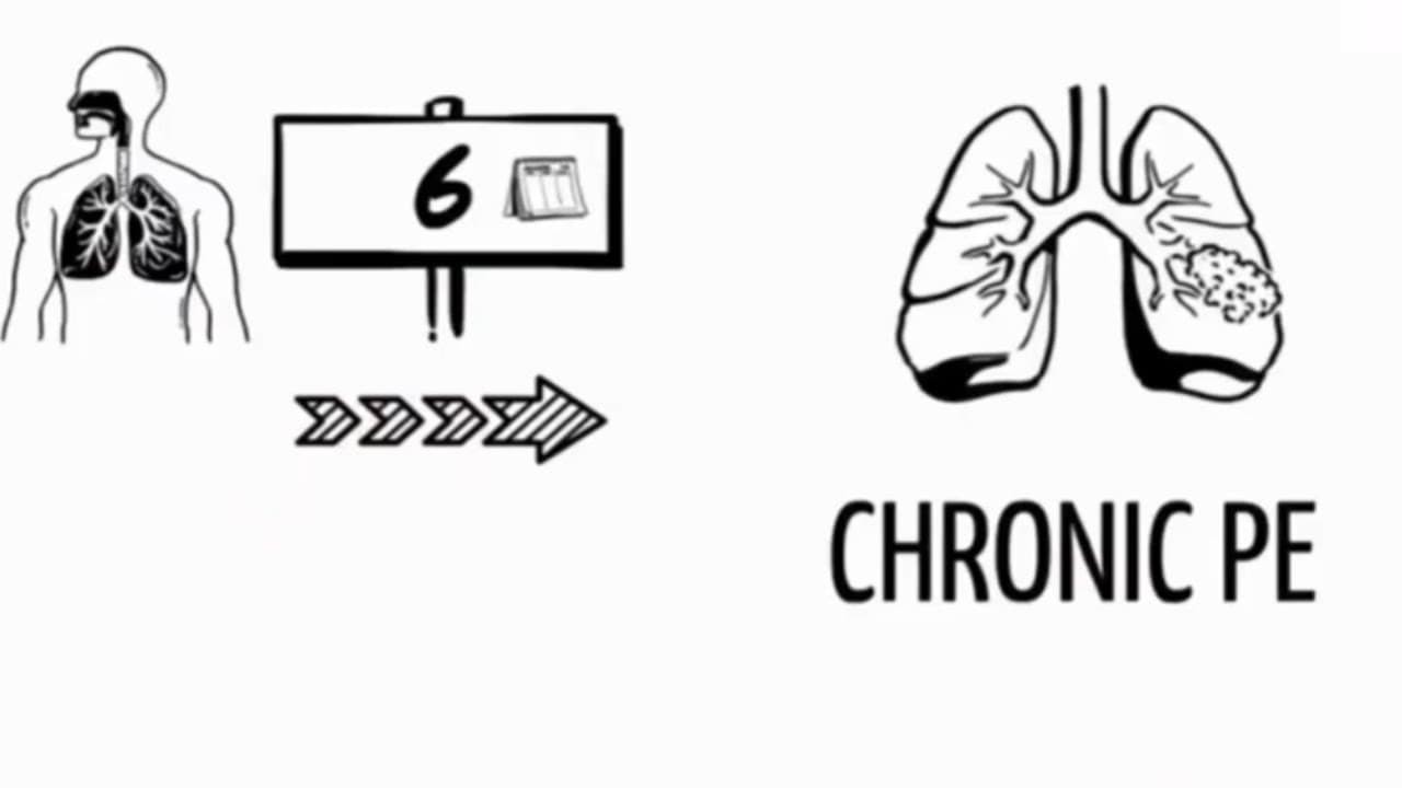 Pulmonary Embolism (PE) Explained: Understanding the Basics and Types