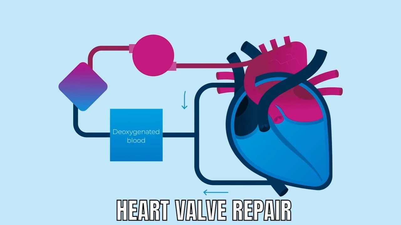 Heart valve replacement Surgery