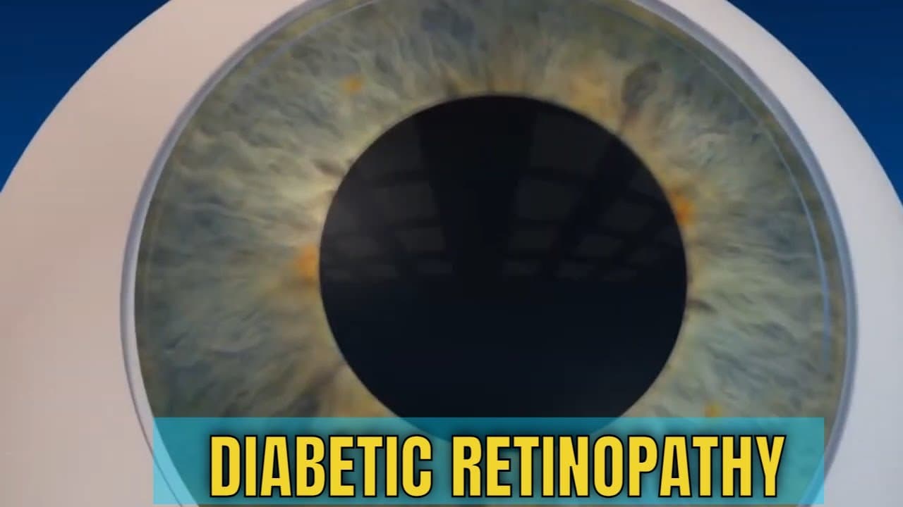 what is Diabetic retinopathy?