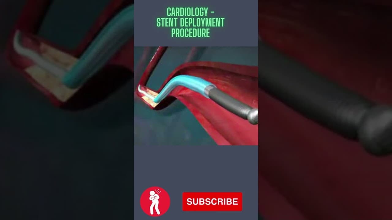 Cardiology Stent Deployment Procedure
