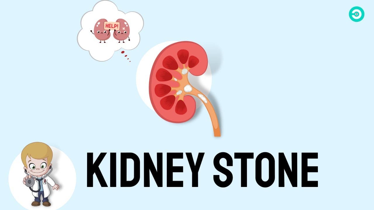 kidney stone: Formation, symptoms, Diagnosis & Surgical Treatment options