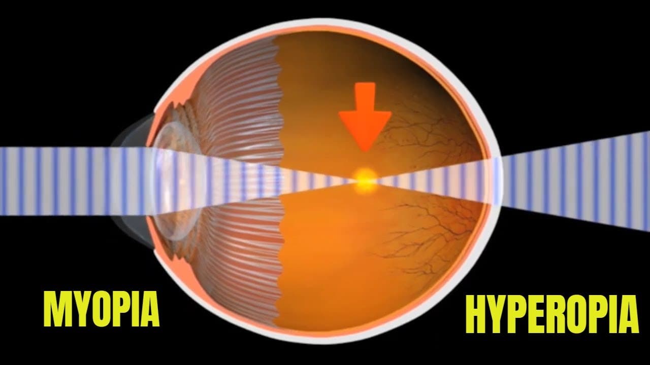 Myopia and Hyperopia