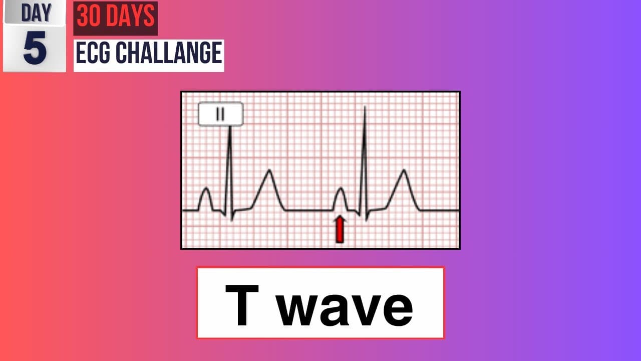 Day 5: Demystifying T Waves | 30-day ECG Challenge