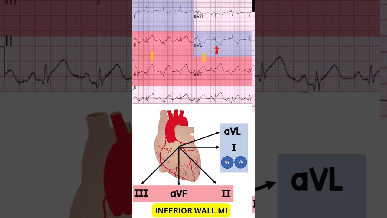 INFERIOR WALL MI #medicaleducation #doctor #hospital #cathlab