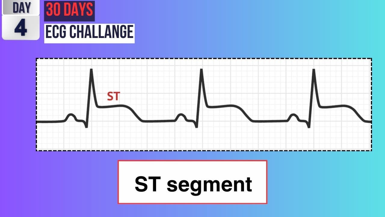 Day 4: Decoding the ST Segment | 30-Day ECG Challenge