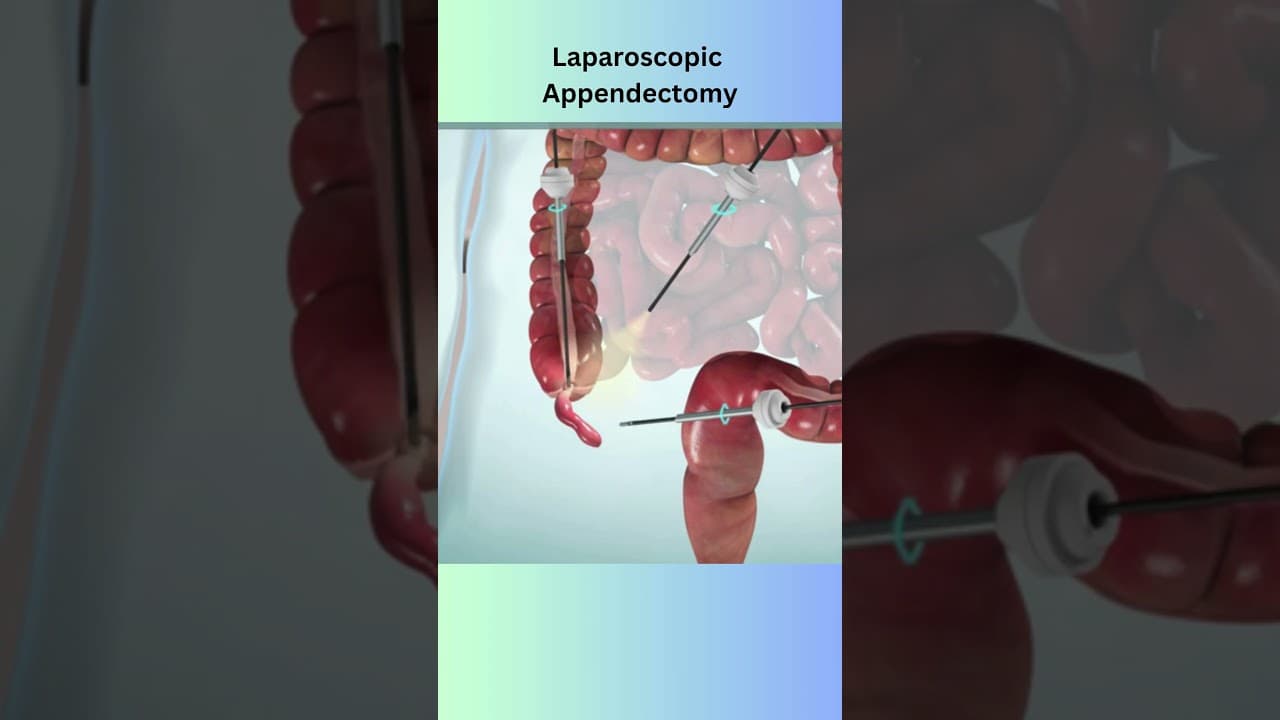 Appendectomy medical animation #medicaleducation #anatomy #surgerysimulator