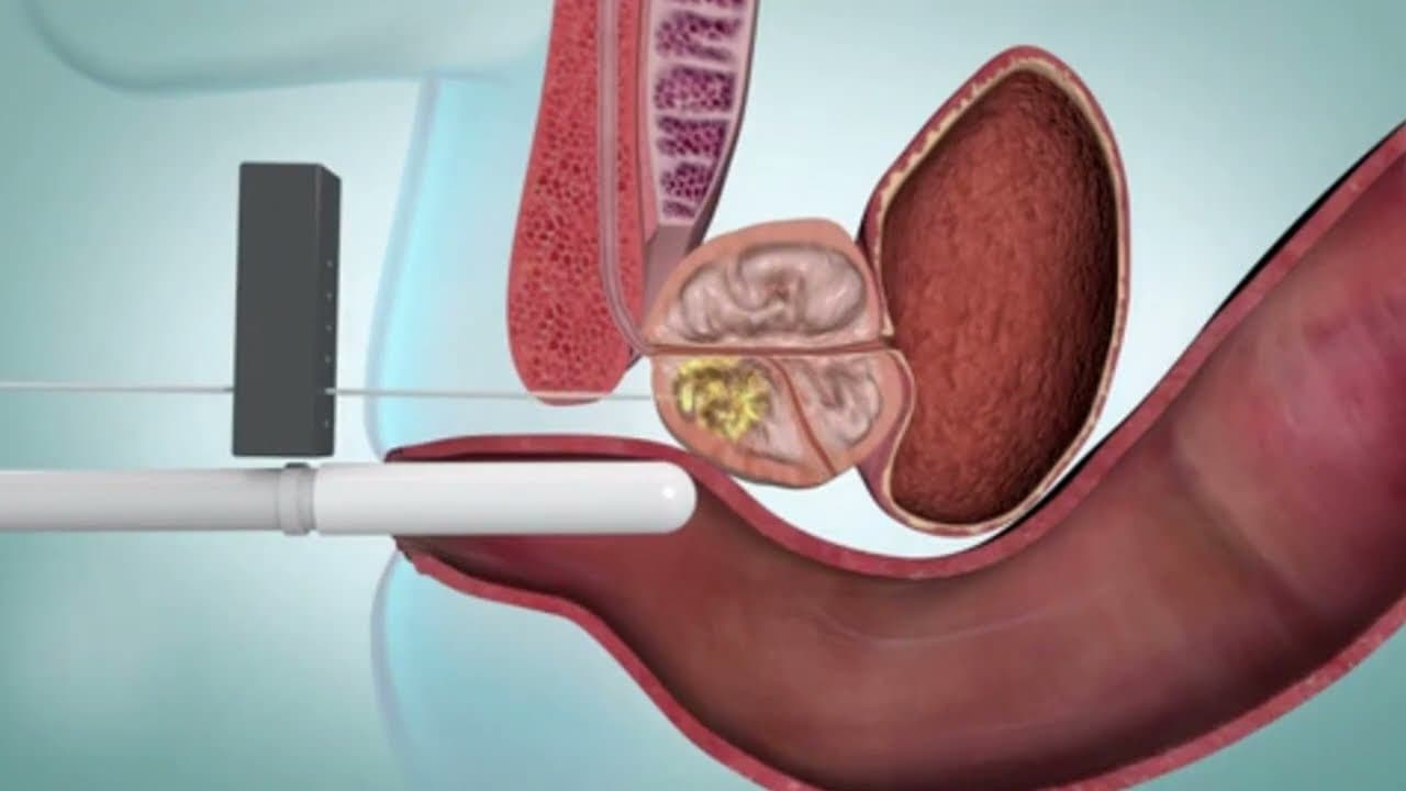 Prostate Biopsy Procedure and protocol (Medical Animation)